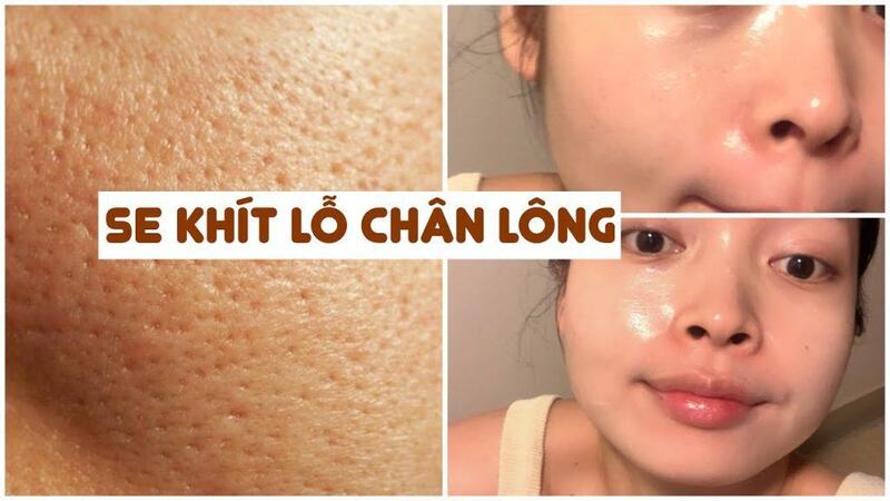 cách trị lỗ chân lông to cho da dầu